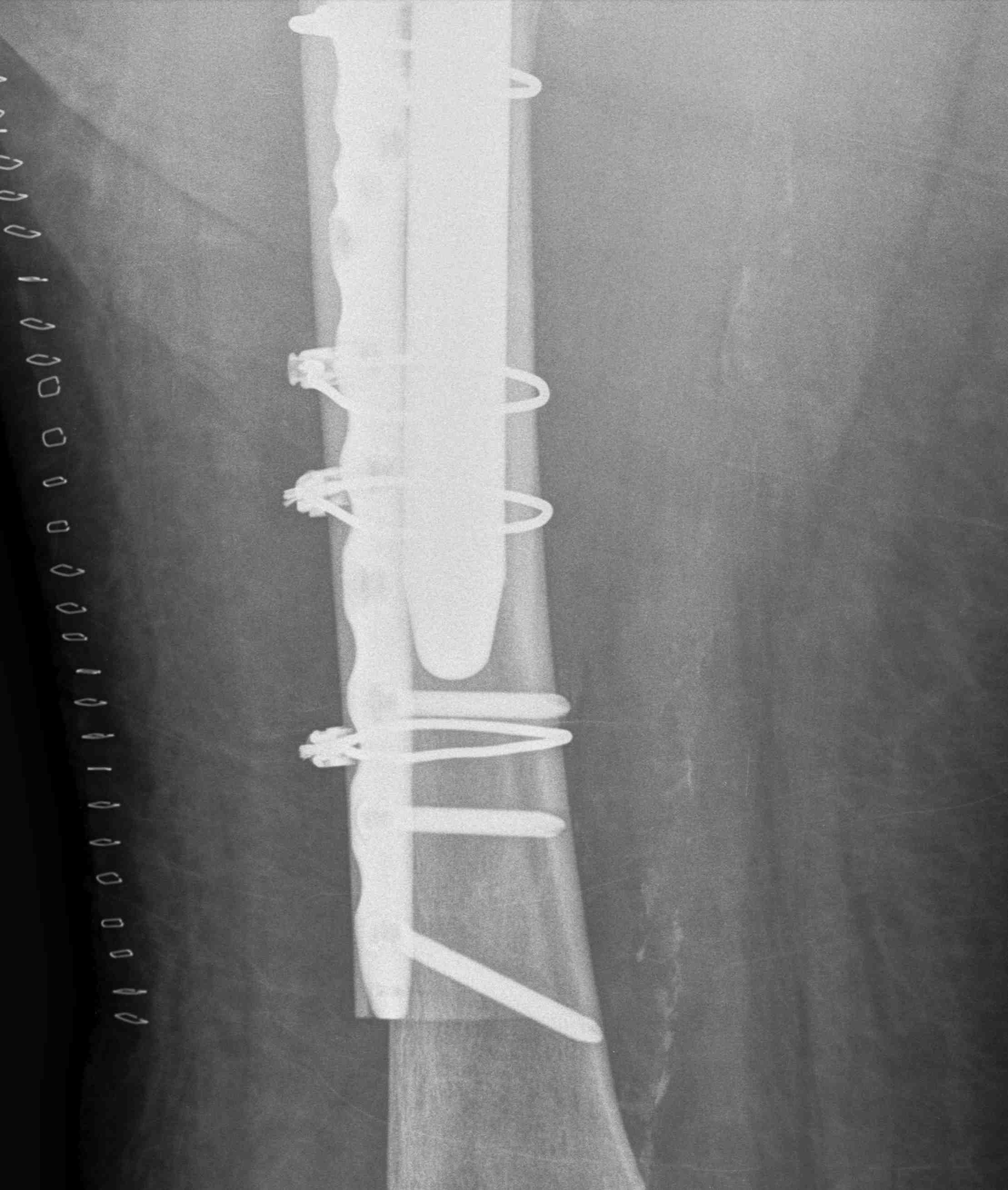 Revision THR Periprosthetic Fracture Uncemented Stem Strut Graft 2